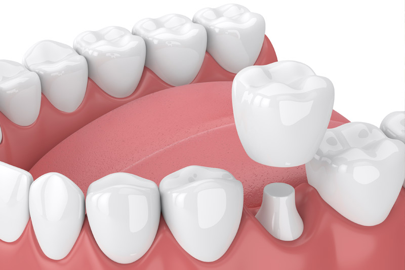 Dental Crowns in Irvine