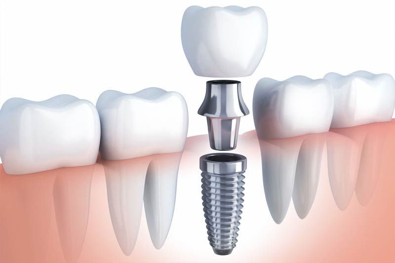 Implants Dentist in Irvine