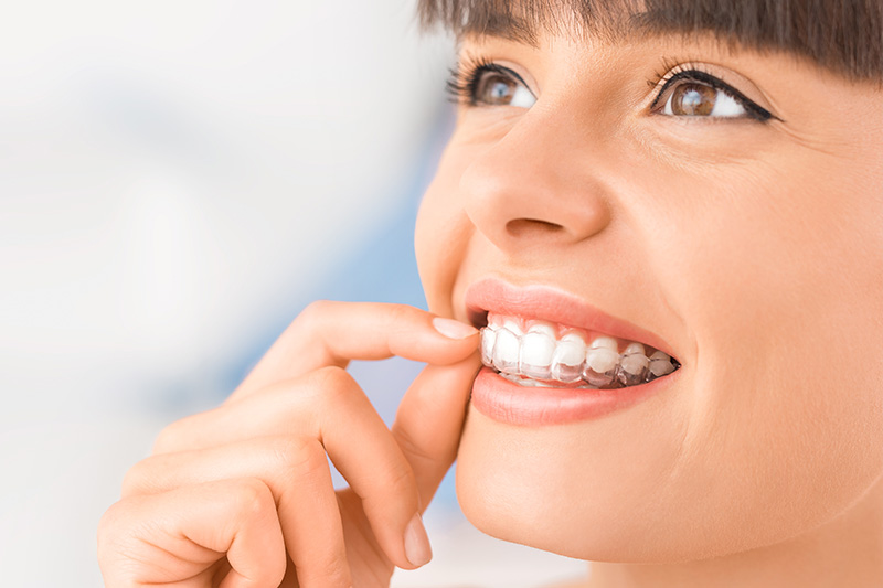 Invisalign in Irvine