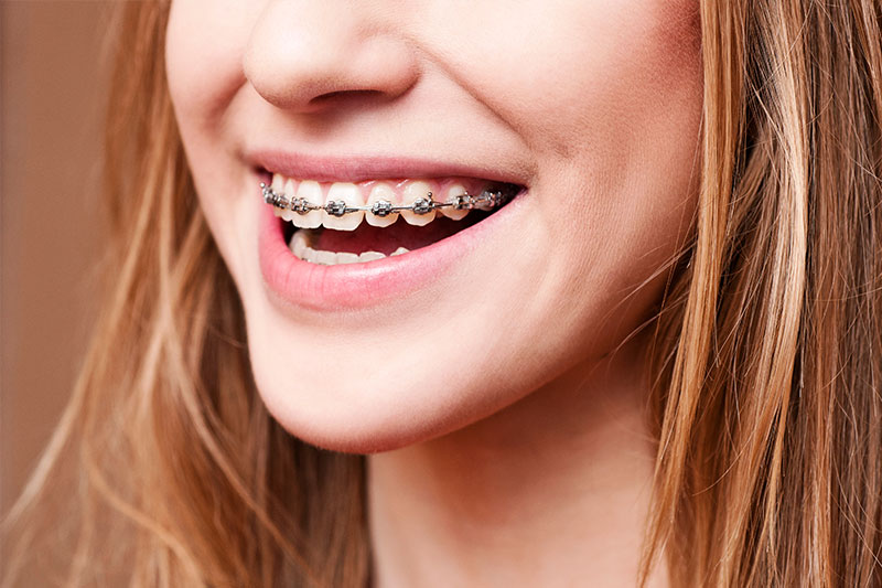 Orthodontics in Irvine