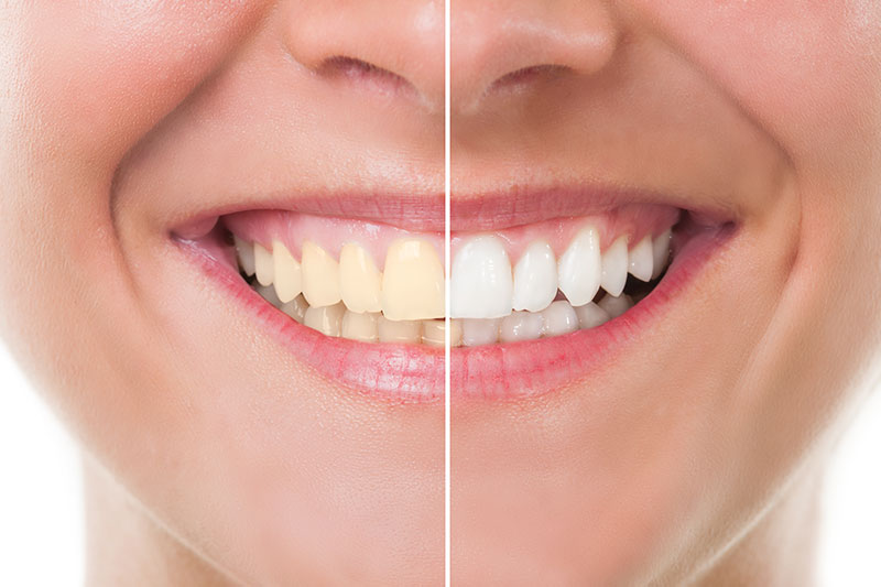 Teeth Whitening in Irvine