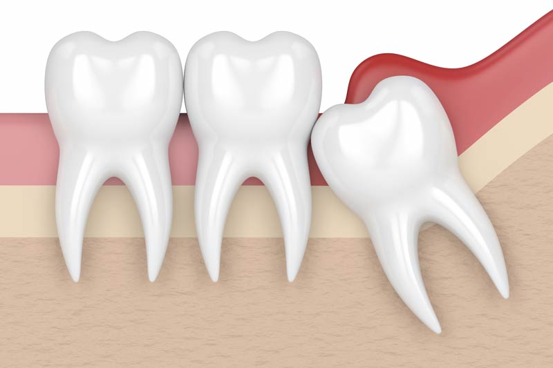 Wisdom Tooth Removal in Irvine
