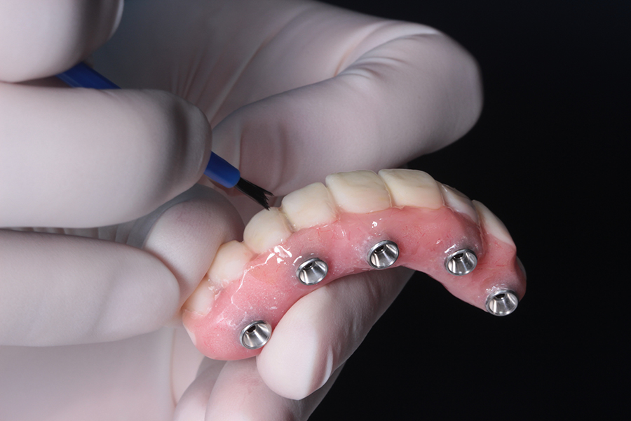 Implants Dentist in Irvine